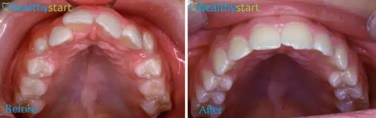 general sleep dentistry precision dental care imperial mo services Pediatric Sleep Disorders healthystart upperarchovercrowding image