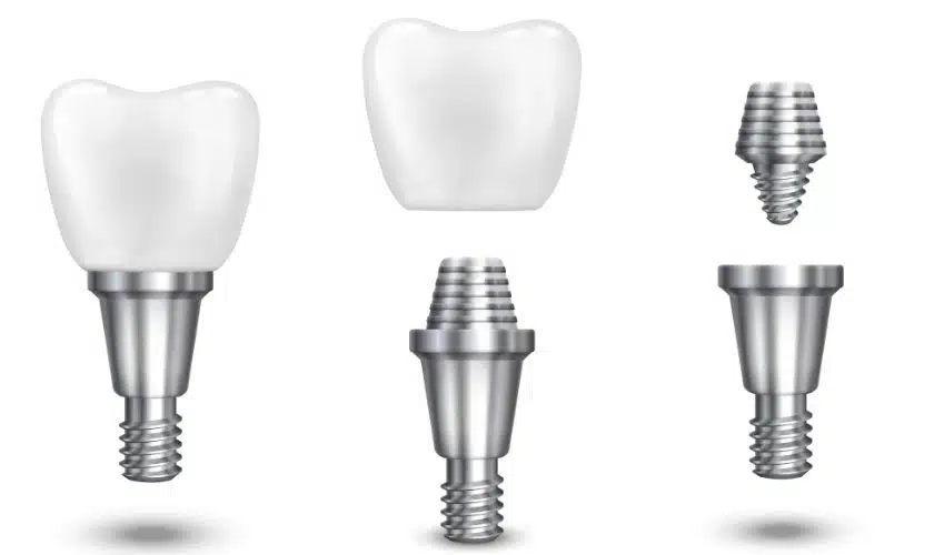 Side Effects Of Dental Implant Surgery One Needs To Be Careful About