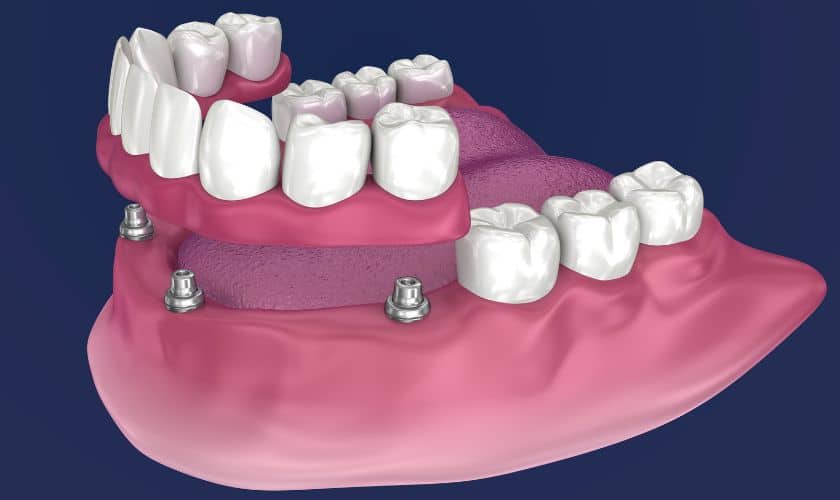 Implant Dentures: A Permanent Solution for Missing Teeth