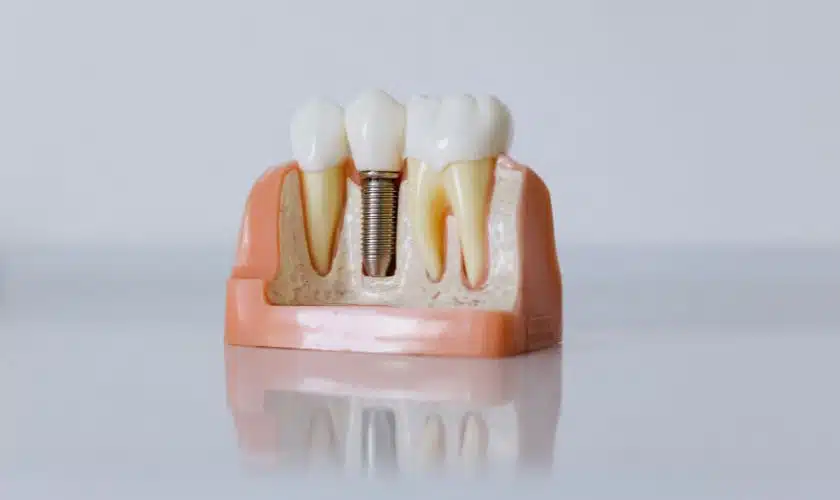 How Long Do Dental Implants Last?