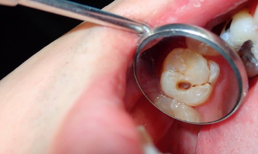 How Can My Family Prevent Tooth Decay?