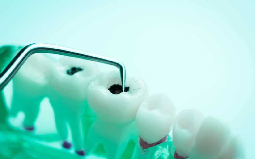 Are Your Genetics to Blame for Frequent Cavities?