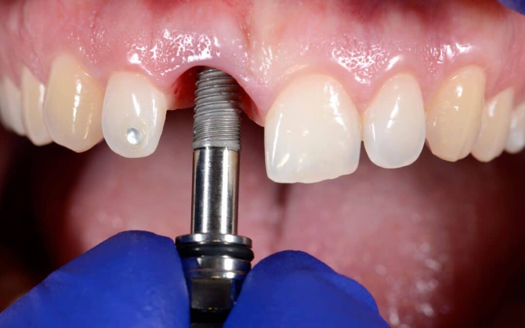 How Long After Dental Implant Surgery Can I Eat?