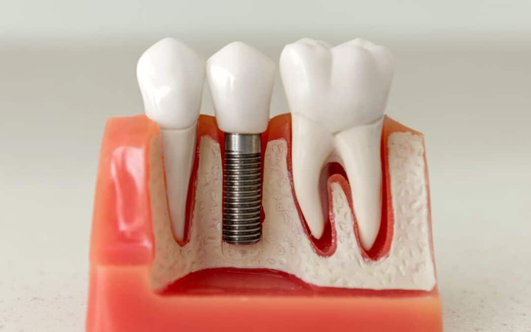 dental implants in Imperial