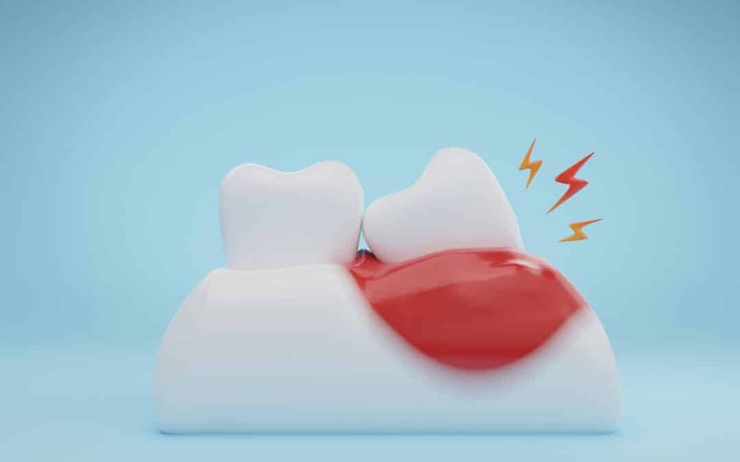 Wisdom Teeth Recovery treatment