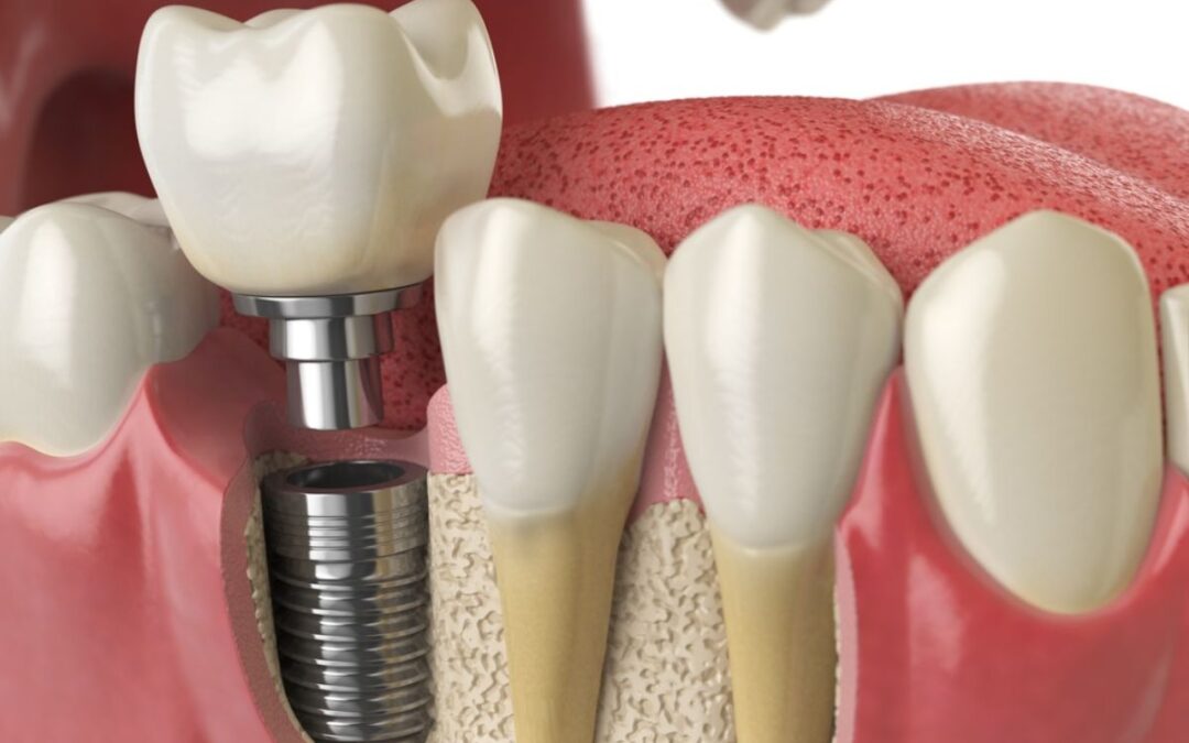 How Painful Are Dental Implants? A Complete Guide for Imperial Patients