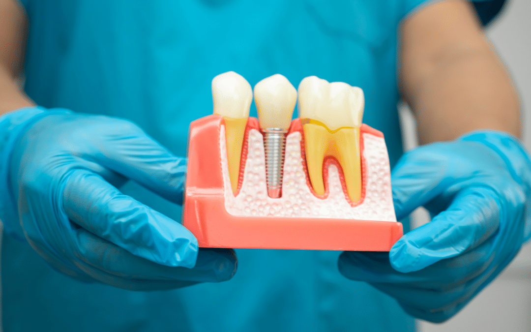 dental implants imperial